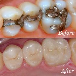 Do Dental Crowns Feel Natural?
