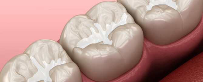 What are Dental Sealants?